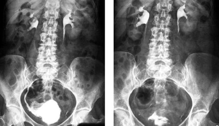 urografija prostatitui diagnozuoti